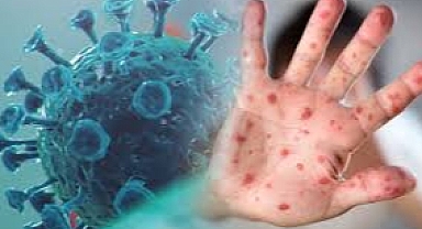 Maymun çiçeği virüsü Avrupa'ya sıçradı!